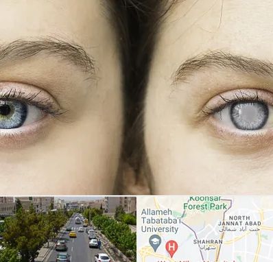 متخصص آب سیاه (گلوکوم) در شهران 