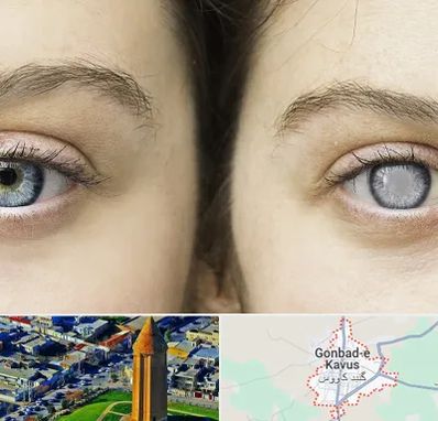 متخصص آب سیاه (گلوکوم) در گنبد کاووس