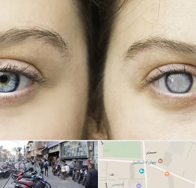 متخصص آب سیاه (گلوکوم) در چهارراه استانبول