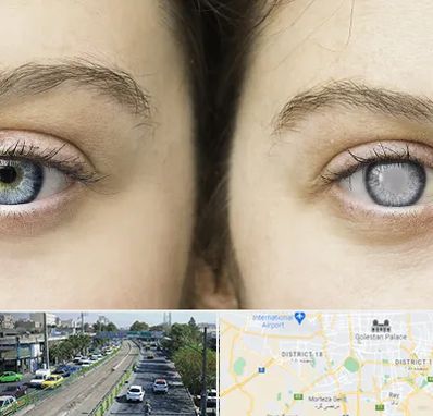 متخصص آب سیاه (گلوکوم) در جنوب تهران 