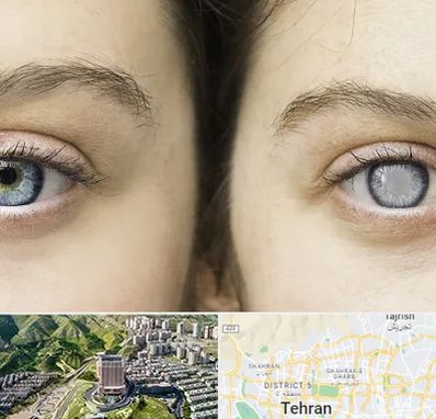 متخصص آب سیاه (گلوکوم) در شمال تهران 