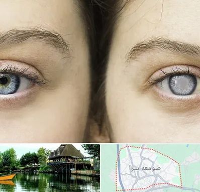 متخصص آب سیاه (گلوکوم) در صومعه سرا
