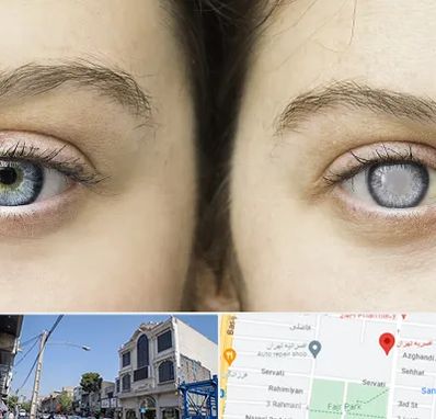 متخصص آب سیاه (گلوکوم) در افسریه 