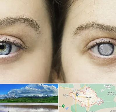 متخصص آب سیاه (گلوکوم) در مرند