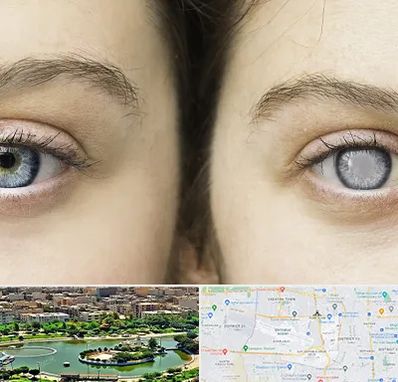 متخصص آب سیاه (گلوکوم) در منطقه 9 تهران 