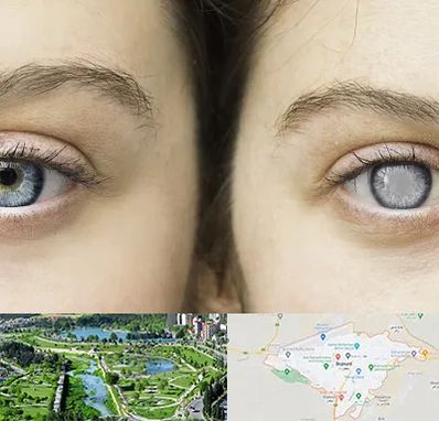 متخصص آب سیاه (گلوکوم) در بجنورد