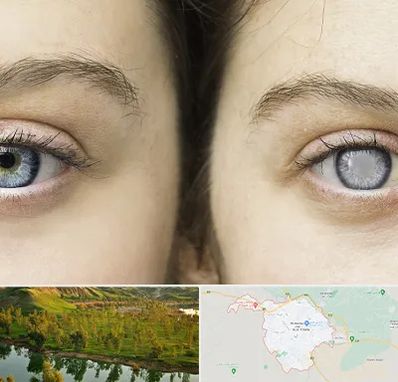 متخصص آب سیاه (گلوکوم) در بهبهان