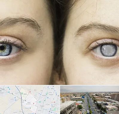 متخصص آب سیاه (گلوکوم) در حصارک کرج