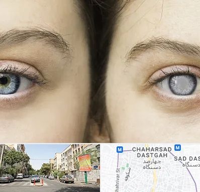 متخصص آب سیاه (گلوکوم) در چهارصد دستگاه 