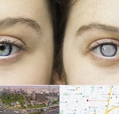 متخصص آب سیاه (گلوکوم) در آیت الله کاشانی