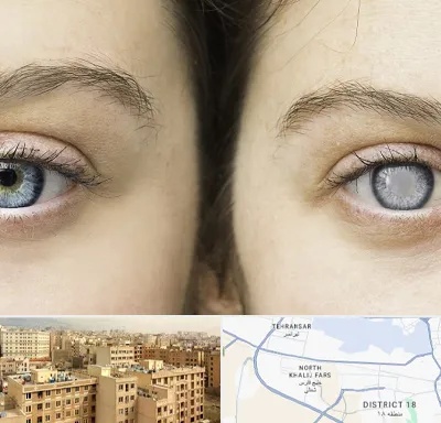 متخصص آب سیاه (گلوکوم) در جنوب غرب تهران