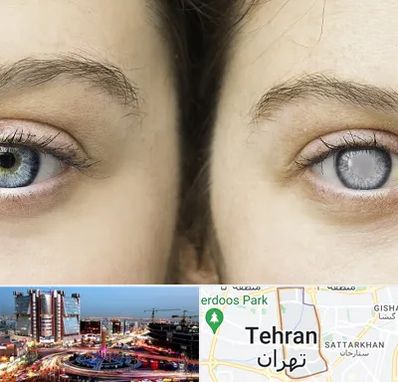 متخصص آب سیاه (گلوکوم) در صادقیه 