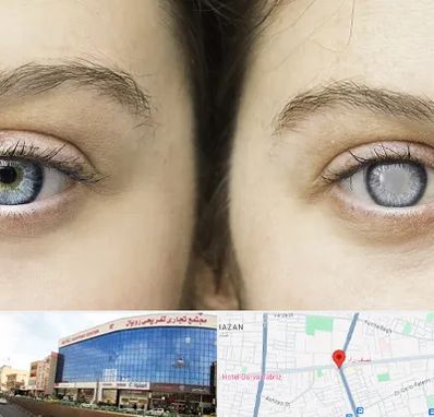 متخصص آب سیاه (گلوکوم) در نصف راه تبریز