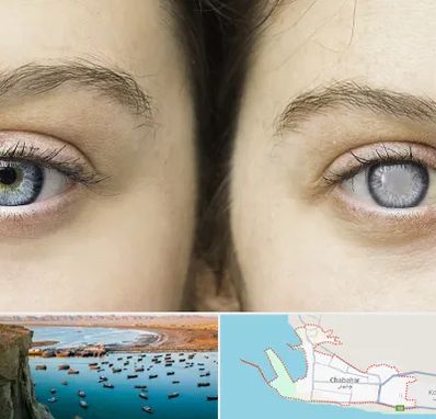 متخصص آب سیاه (گلوکوم) در چابهار