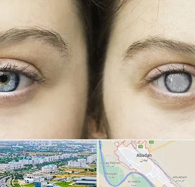 متخصص آب سیاه (گلوکوم) در آبادان