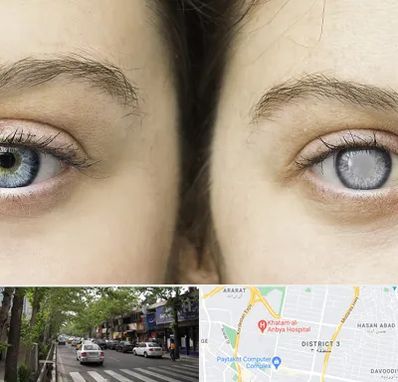 متخصص آب سیاه (گلوکوم) در ظفر 