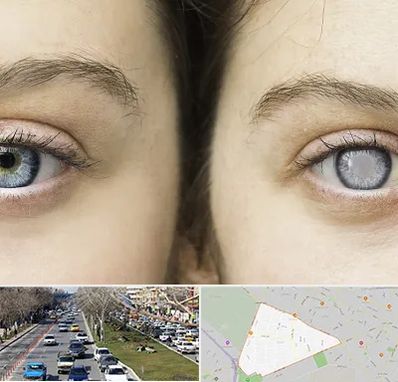 متخصص آب سیاه (گلوکوم) در احمدآباد مشهد 