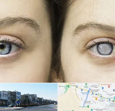 متخصص آب سیاه (گلوکوم) در شریعتی مشهد