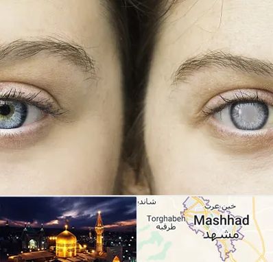 متخصص آب سیاه (گلوکوم) در مشهد