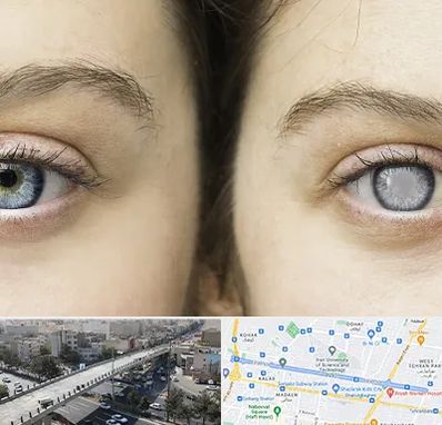 متخصص آب سیاه (گلوکوم) در فرجام