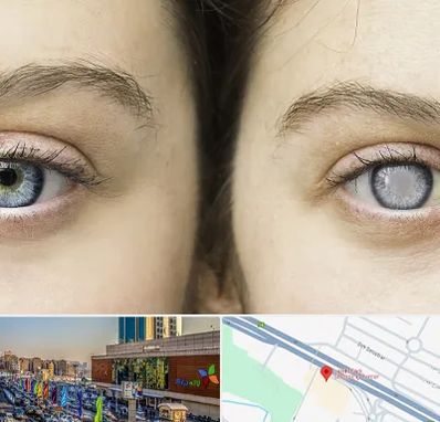 متخصص آب سیاه (گلوکوم) در لاله پارک تبریز