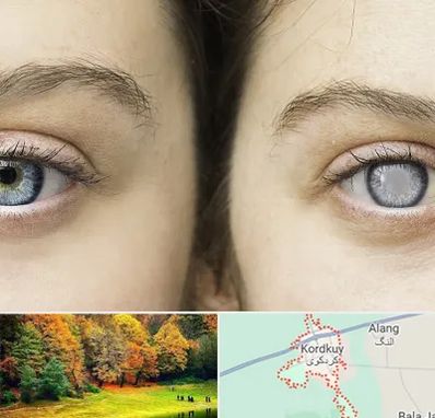 متخصص آب سیاه (گلوکوم) در کردکوی