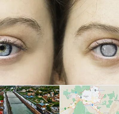 متخصص آب سیاه (گلوکوم) در مراغه