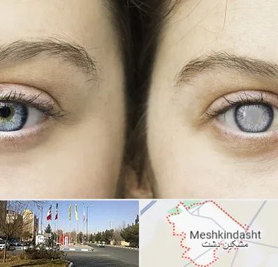 متخصص آب سیاه (گلوکوم) در مشکین دشت