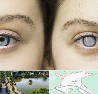 متخصص آب سیاه (گلوکوم) در لنگرود