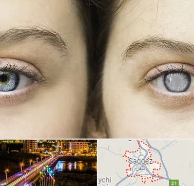 متخصص آب سیاه (گلوکوم) در سقز