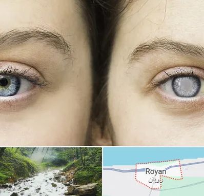 متخصص آب سیاه (گلوکوم) در رویان