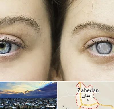 متخصص آب سیاه (گلوکوم) در زاهدان