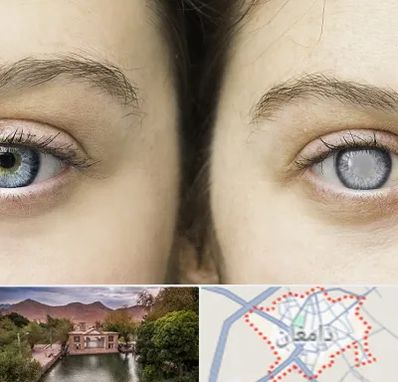 متخصص آب سیاه (گلوکوم) در دامغان