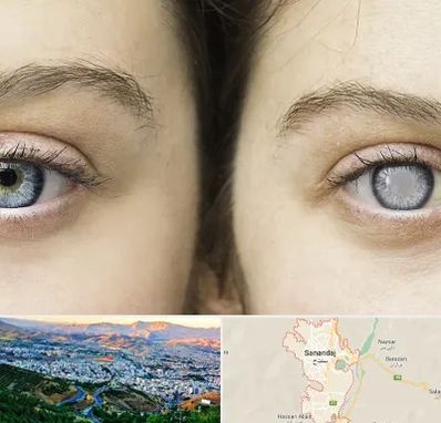 متخصص آب سیاه (گلوکوم) در سنندج