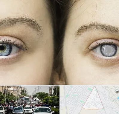 متخصص آب سیاه (گلوکوم) در سیدی مشهد