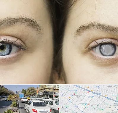 متخصص آب سیاه (گلوکوم) در مفتح مشهد