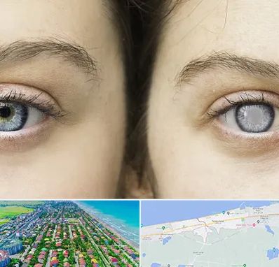 متخصص آب سیاه (گلوکوم) در فریدونکنار