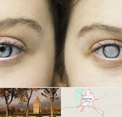 متخصص آب سیاه (گلوکوم) در تویسرکان