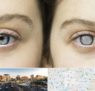 متخصص آب سیاه (گلوکوم) در منطقه 7 تهران 