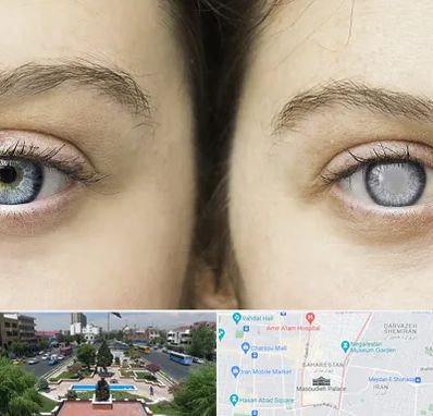 متخصص آب سیاه (گلوکوم) در بهارستان 