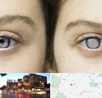 متخصص آب سیاه (گلوکوم) در بلوار سجاد مشهد 