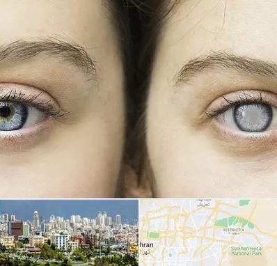 متخصص آب سیاه (گلوکوم) در شرق تهران 