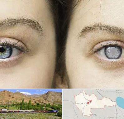 متخصص آب سیاه (گلوکوم) در خاش