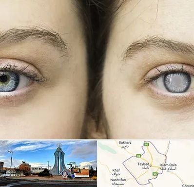 متخصص آب سیاه (گلوکوم) در تایباد