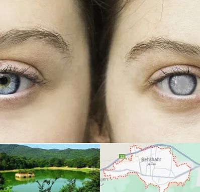 متخصص آب سیاه (گلوکوم) در بهشهر