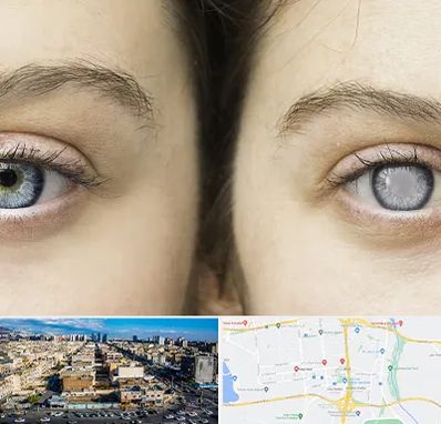 متخصص آب سیاه (گلوکوم) در شهرک راه آهن