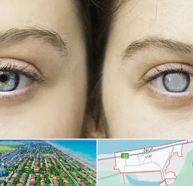 متخصص آب سیاه (گلوکوم) در نور