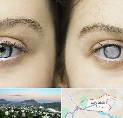 متخصص آب سیاه (گلوکوم) در لواسان