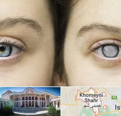 متخصص آب سیاه (گلوکوم) در خمینی شهر