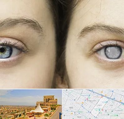 متخصص آب سیاه (گلوکوم) در هاشمیه مشهد